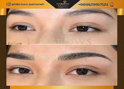 یک پیشنهاد ویژه برای انجام میکروبلیدینگ