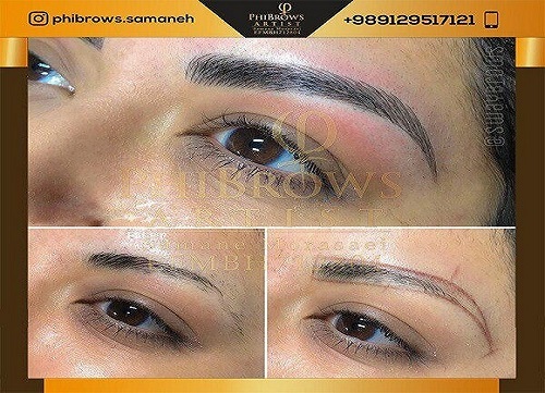 میکروبلیدینگ در ونک