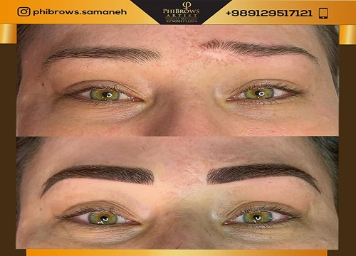 میکروبلیدینگ چشم