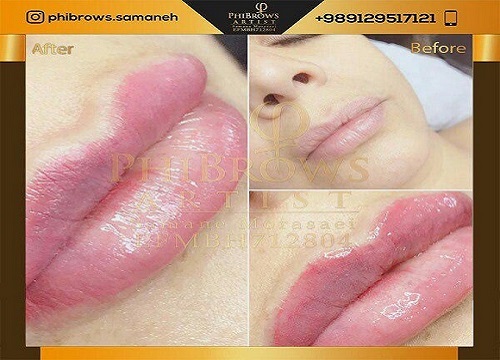 میکروپیگمنتیشن لب