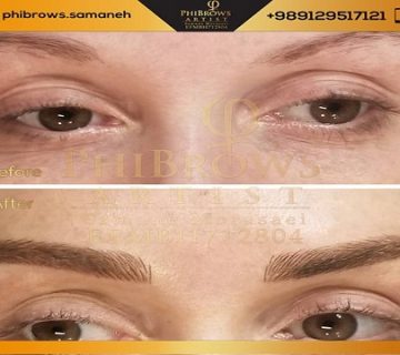 عوارضی که بعد از میکروبلیدینگ شما را تهدید می کند: